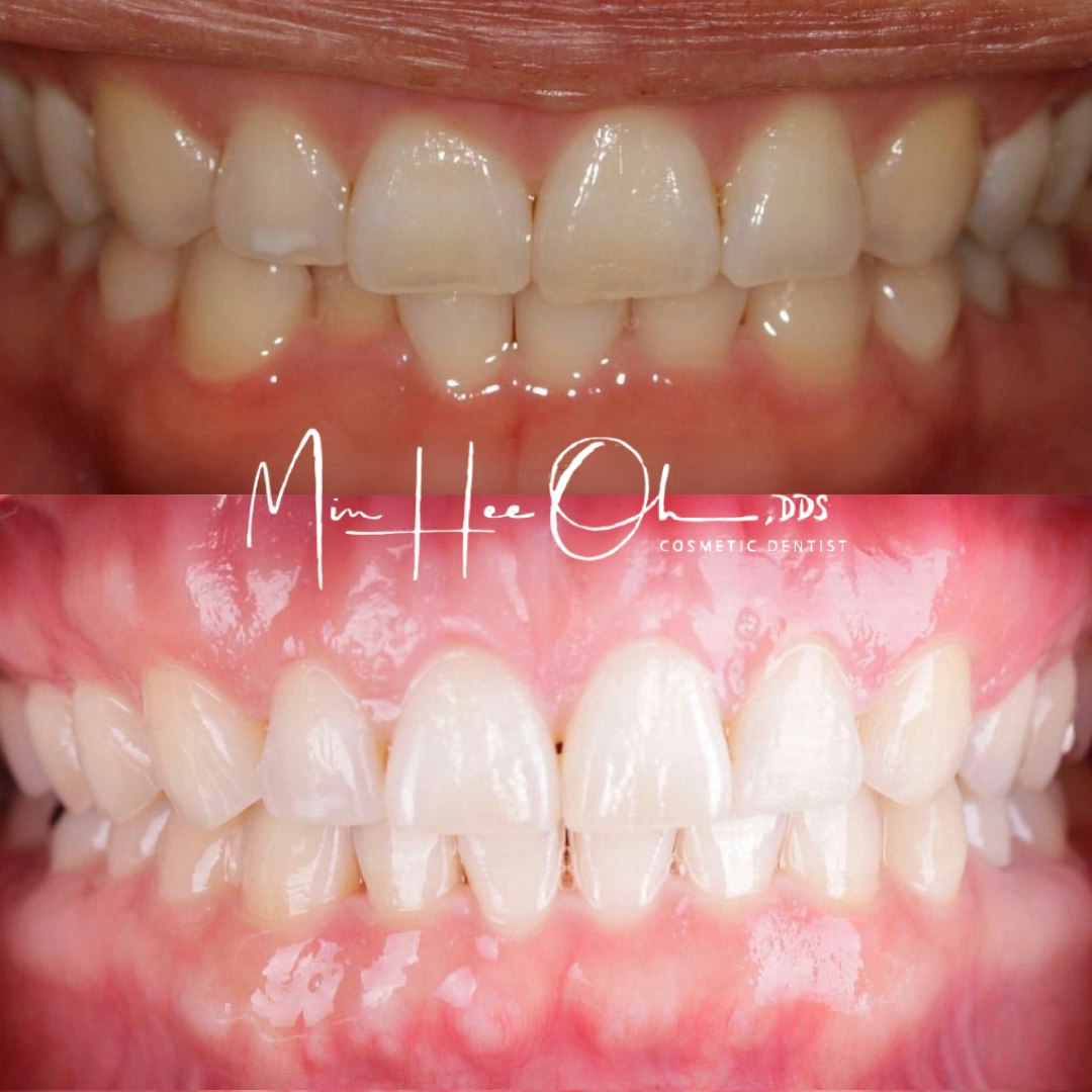 Before and after cosmetic dentistry smile by Dr. Min Hee Oh in Los Angeles