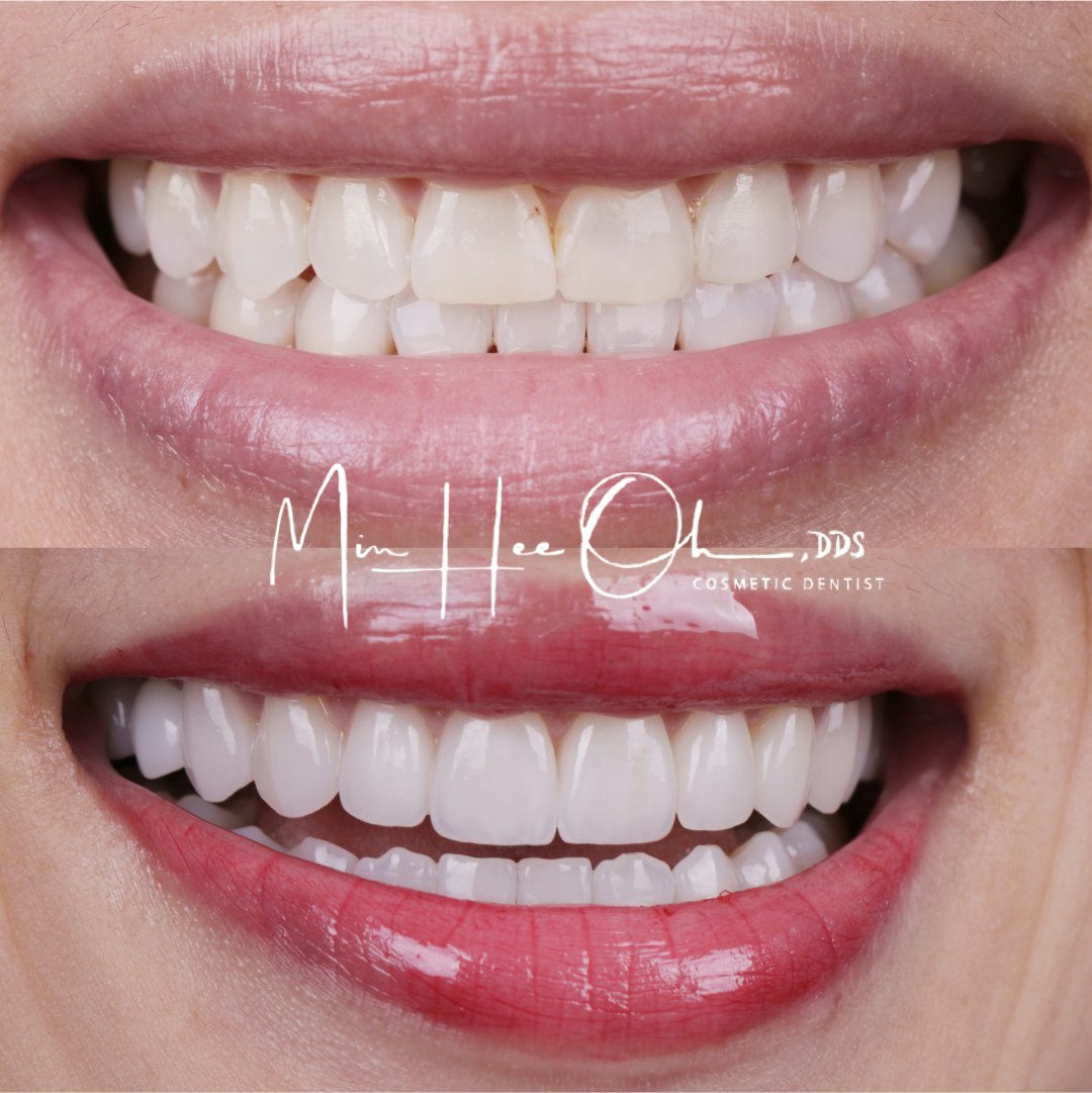 Before and after porcelain veneer smile by Dr. Min Hee Oh in Los Angeles