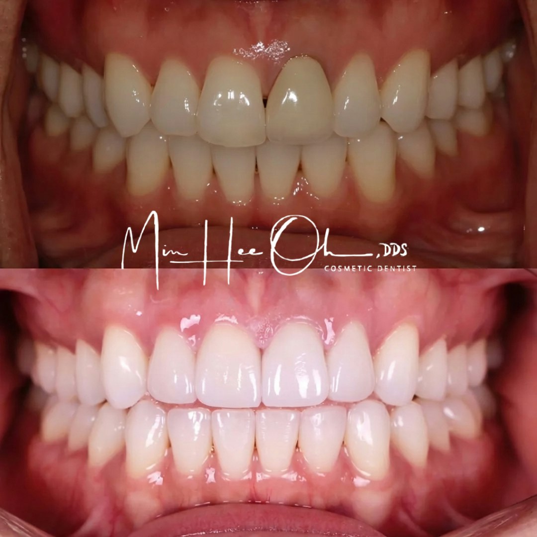 Before and after porcelain veneers closing a front-tooth gap by Dr. Min Hee Oh