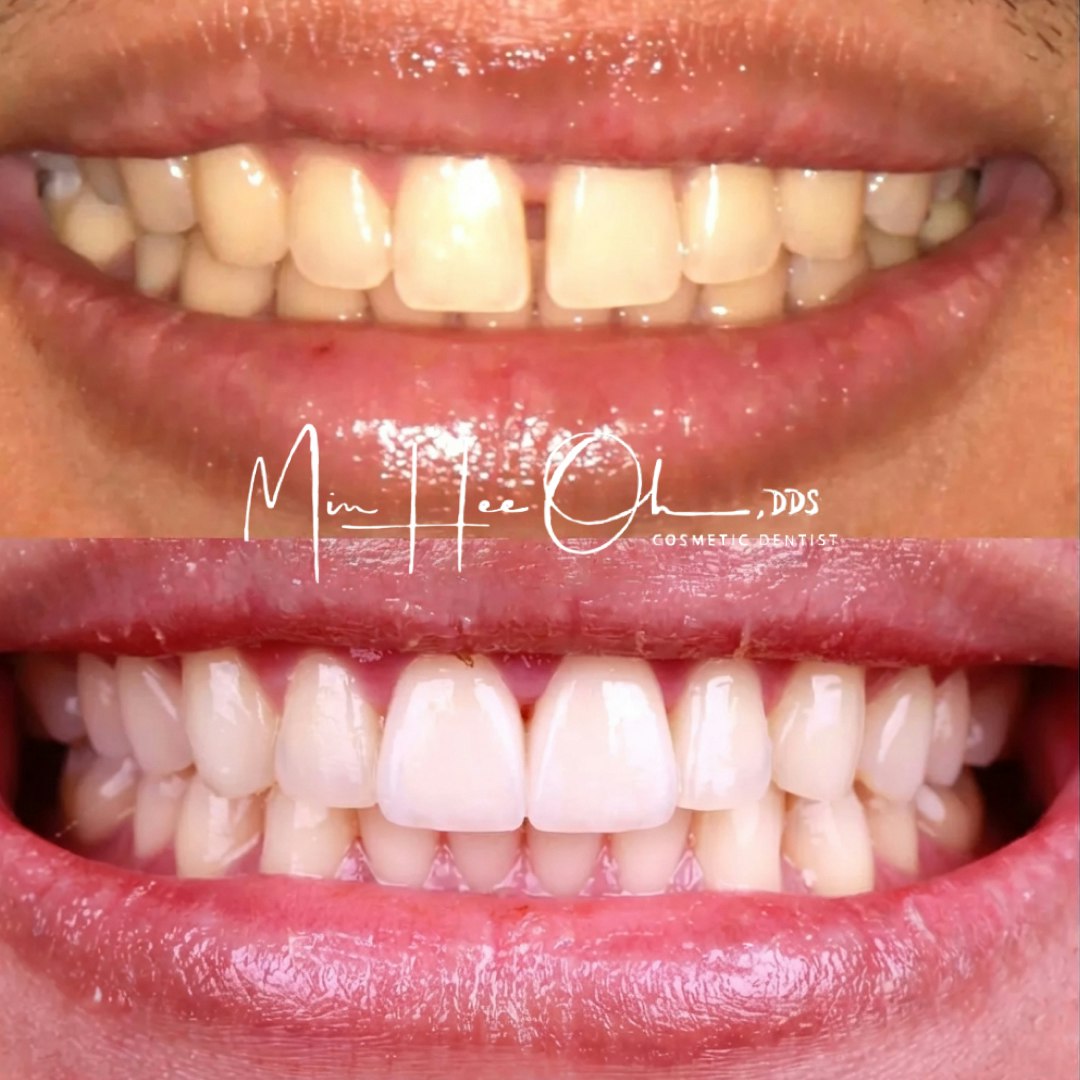 Before and after porcelain veneers closing a diastema by Dr. Min Hee Oh