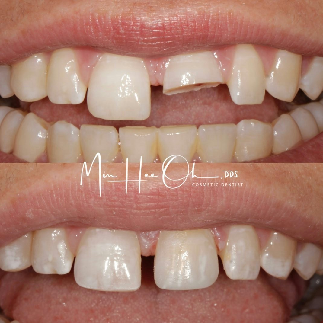 Before and after repair of a chipped front tooth by Dr. Min Hee Oh