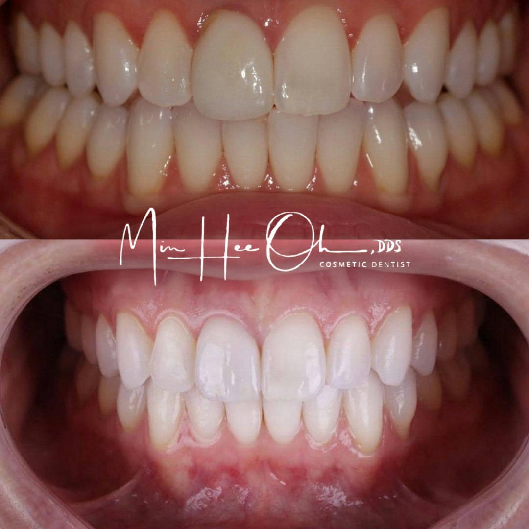 Before and after restored smile by Dr. Min Hee Oh
