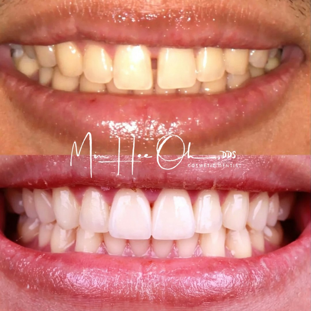 Before and after smile with a closed front-tooth gap by Dr. Min Hee Oh