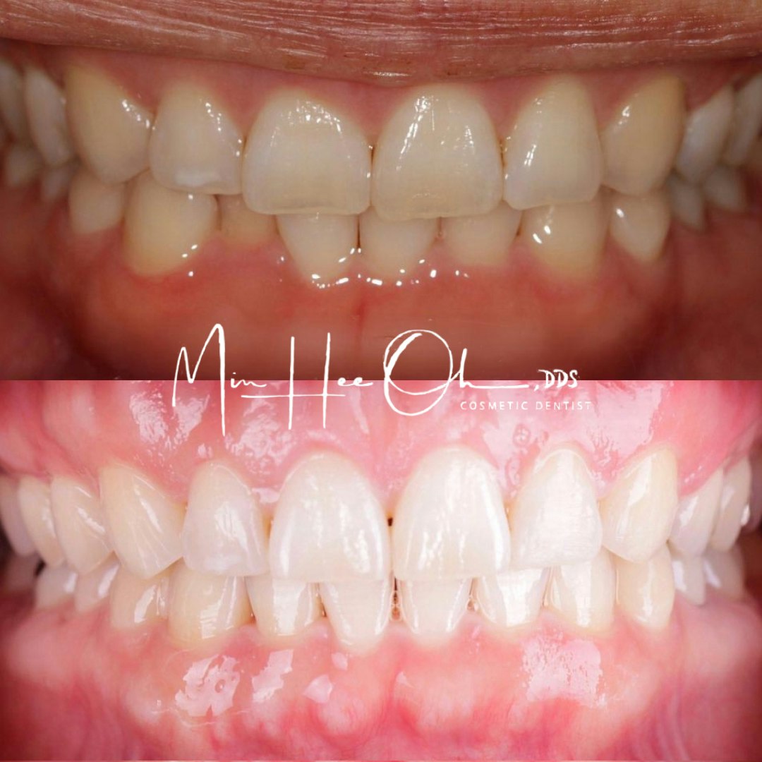Before and after teeth whitening as part of a smile makeover by Dr. Min Hee Oh